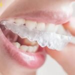 aligners may be harmful