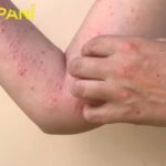 Monkey Pox Alert in Islamabad and Sindh