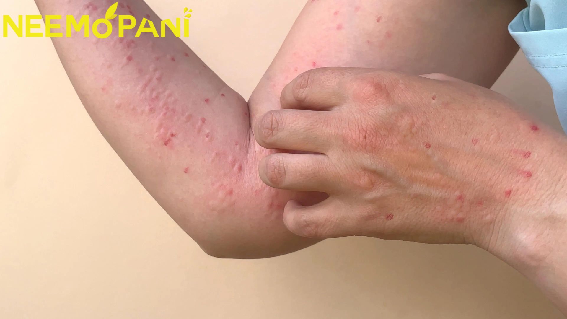 Monkey Pox Alert in Islamabad and Sindh